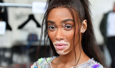 Vitiligo model winnie harlow