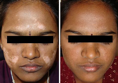 Vitiligo nbUVB Treatment Protocol - University of …