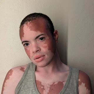 Vitiligoftmboi Leaked [HD] 🍌 228 Photos