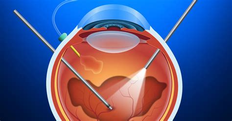 Vitrectomy and Vitreoretinal Procedures - All About Vision