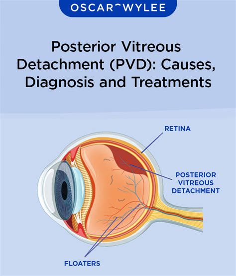Vitreous detachment What it is causes and risk factors