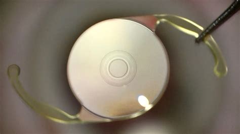 Vivity lens problems.  Jun 9, 2024 · The Vivity IOL, or Vivity Extended Vision Intrao...