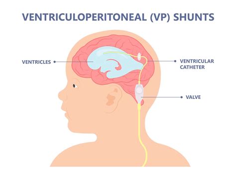 Vp shunt
