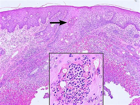Discussion: Vulvar sebaceous adenitis/vulvar acne is a clinically identifiable cause of painful recurrent inflammatory lesions affecting the labia minora and the inner labia majora, which are .... 