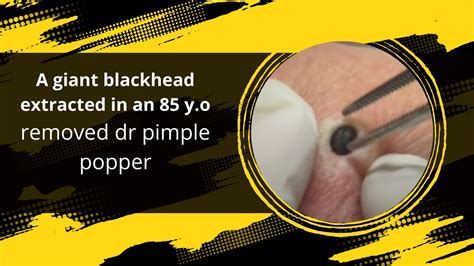 WATCH: Giant Blackhead Removal by Dr. Pimple Popper