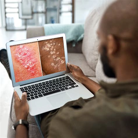 WebMD Skin Problems & Treatments Guide: Chronic … - muktibox.com