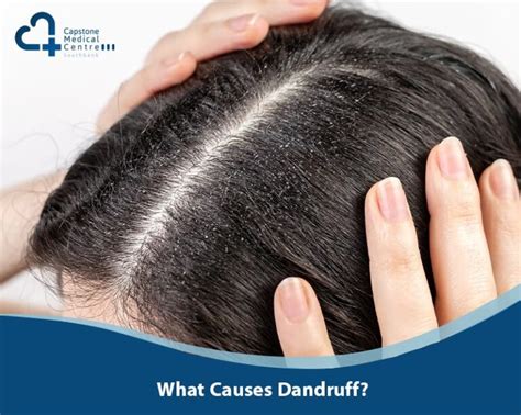 What Causes Dandruff and How Do Scalp Treatments Help | - balustradellc