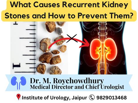 What causes kidney stones and ways you can try to … - balustradellc