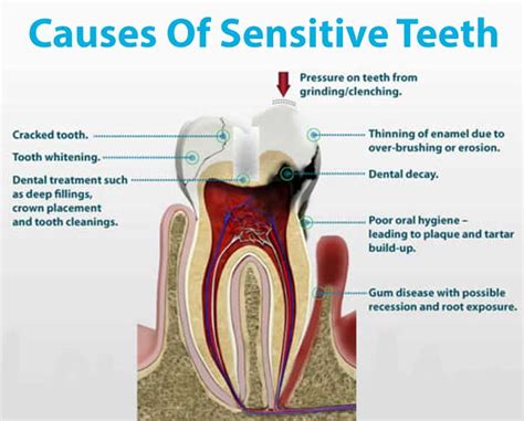 What Causes Tooth Sensitivity and How to Treat It - balustradellc