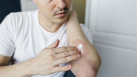 What doctors wish patients knew about managing eczema - balustradellc