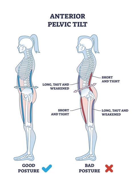 What Is Anterior Pelvic Tilt & How Do You Fix It? - balustradellc
