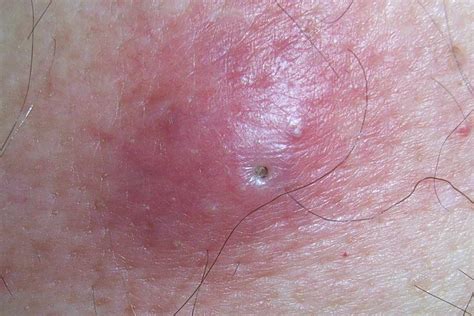 What to do if you have an infected ingrown hair - Patient - balustradellc