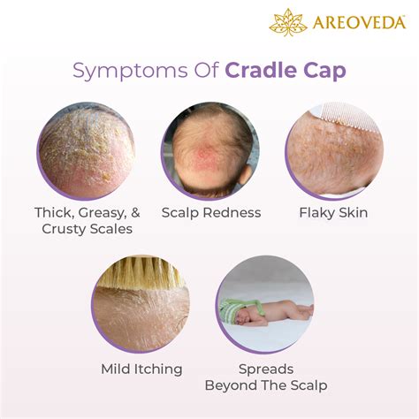 When Does Cradle Cap Stop - balustradellc