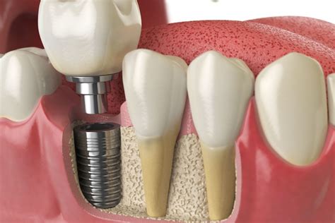 Why Dental Implants are Considered the Best Solution In Modern ... - balustradellc
