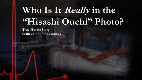 Much like the story of the Chernobyl firefighters, when Hisashi Ouchi was brought to the hospital, he looked totally fine. This is called "walking ghost phase" with severe radiation poisoning: the patient will not initially have any outward marks, scars or burns.. 