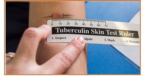 The TB skin test, also called the purified protein derivative (PPD) test or Mantoux test, shows if you've ever been infected with the bacteria that cause tuberculosis. Infections with these bacteria can be active or inactive. In active infections, there usually is a high bacterial load, and the person is contagious when he or she coughs.. 