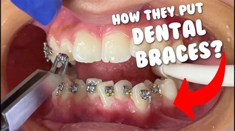 Walt Orthodontics on Instagram: "Ever wondered how we put our braces …