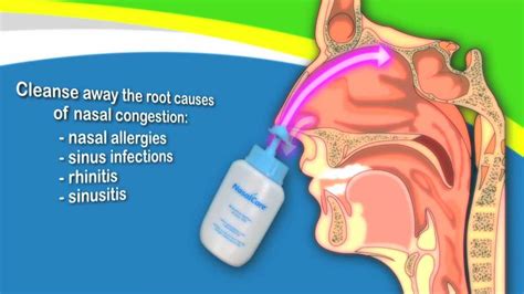 Warning about Nasal Rinses!! Learn from my mistake. ScubaBoard