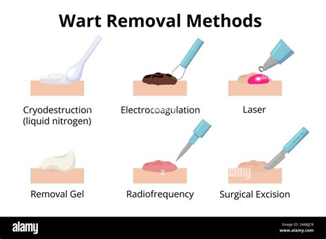 Wart removal.  Learn which removal methods are safe, what to avoid, and how ...