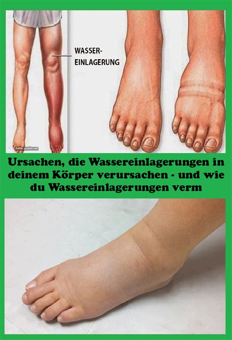 Wassereinlagerungen: ursachen