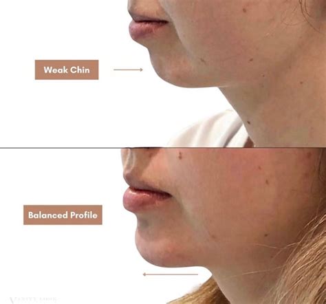 Weak chin What it is and ways to fix
