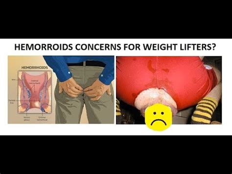 Weightlifters And Hemorrhoids - abablearthritis.com