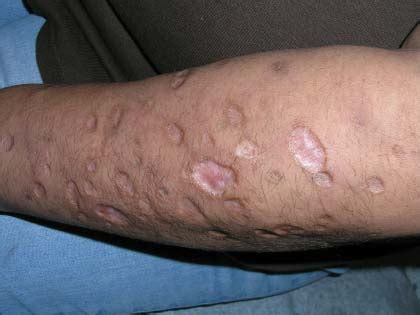 Weird circular marks on arm Dermatology Forums Patient