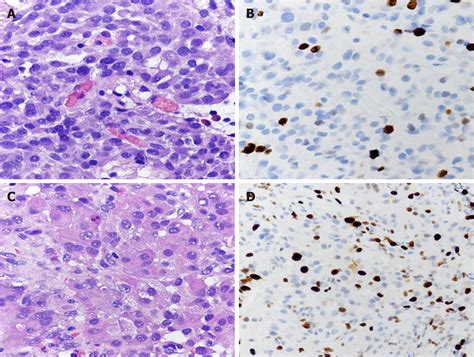 Well-differentiated neuroendocrine (carcinoid) tumor? - AAPC