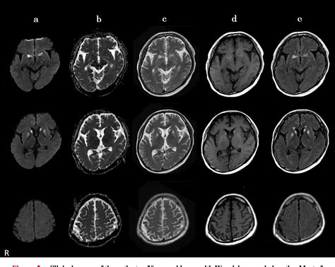 Wernicke-Korsakoff Syndrome - Neurology - Medbullets Step 2/3