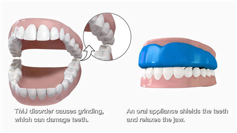 There is a serious need to consider all potential side effects thoughtfully before commencing individual treatment with oral appliance therapy. Although many of these side effects …