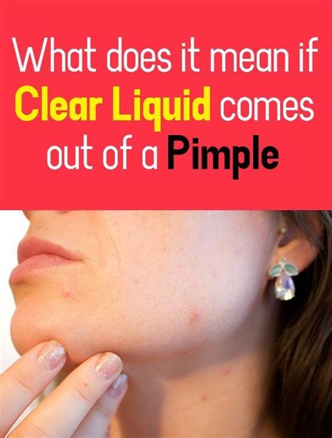 What's the clear liquid that comes out of pimples. This is a skin condition that causes red, itchy, scaly patches. An infection, stress, certain chemicals, and some medications can all trigger an attack of pustular psoriasis. Rosacea. This skin ... 