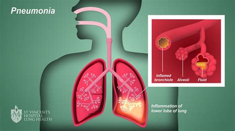 What’s New in Pneumonia – Nothing Really AffloVest