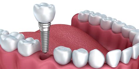 What Are Dental Implants and What Are They Used For?