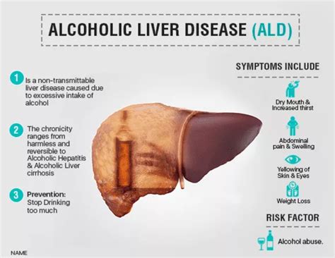 What Are the First Signs of Alcoholic Liver Disease?