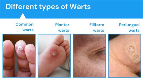 What Causes Warts, and What Should I Do About the …