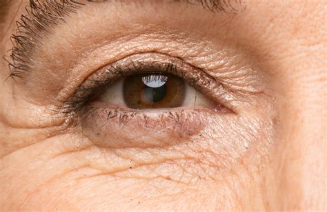 What Causes Wrinkles Around the Eyelids (and How Can