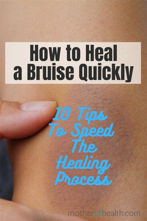 What Causes a Bruise and How It Can Heal Faster
