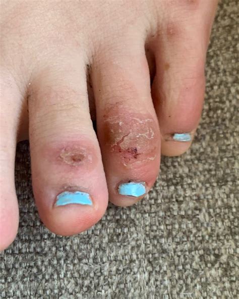 What Do COVID Toes Feel Like? Doctors Explain The Symptom - Bustle