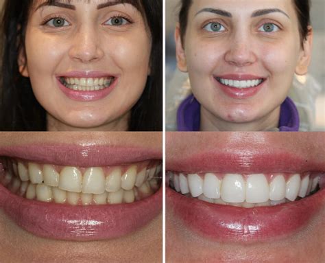 What Do You Need to Consider for a Full Set of Veneers?