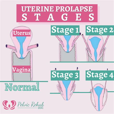 What Is A Prolapsed Uterus Picture