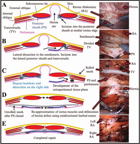 What Is Abdominal Wall Reconstruction? - MedicineNet