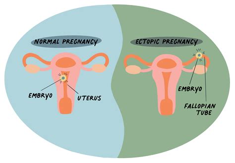 What Is An Ectopic Pregnancy? - The Ectopic Pregnancy Trust