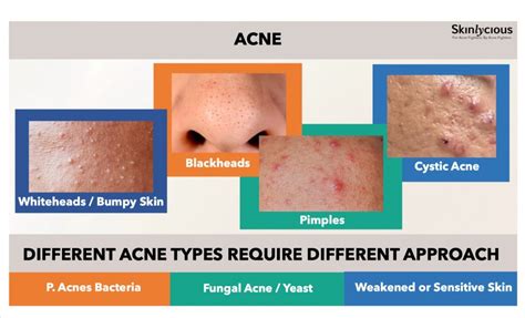 What Is Bacterial Acne? Skincare.com