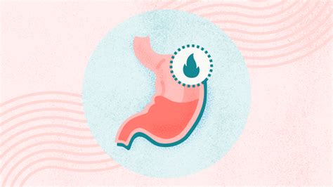 What Is GERD Symptoms Causes Diagnosis Treatment and Prevention Everyday Health