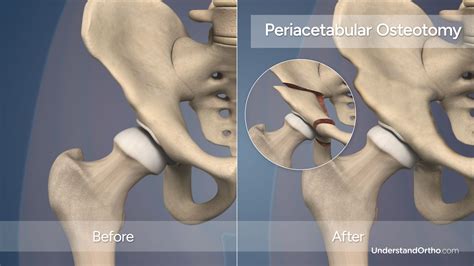 What Is Hip Osteotomy Surgery? Femoral/PAO