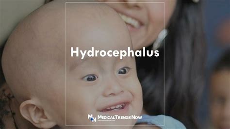 What Is Hydrocephalus