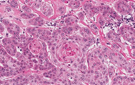 What Is Invasive Moderately Differentiated Squamous Cell Carcinoma