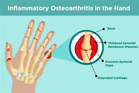 What Is Osteoarthritis? Arthritis-health