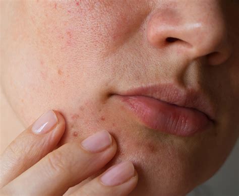 What Is Perioral Dermatitis? Symptoms, Causes, Diagnosis, Treatment ...