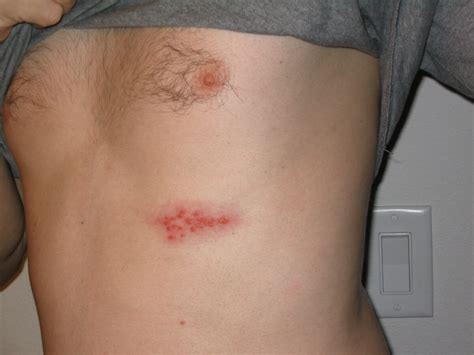 What Is Shingles (Herpes Zoster)? - American Academy of …